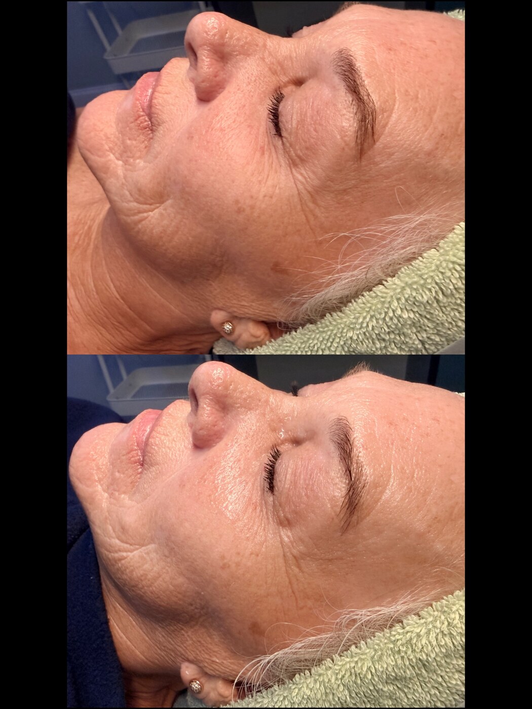 Cheek Filler  Midface Volume before and after at Serene Med Spa Hudson
