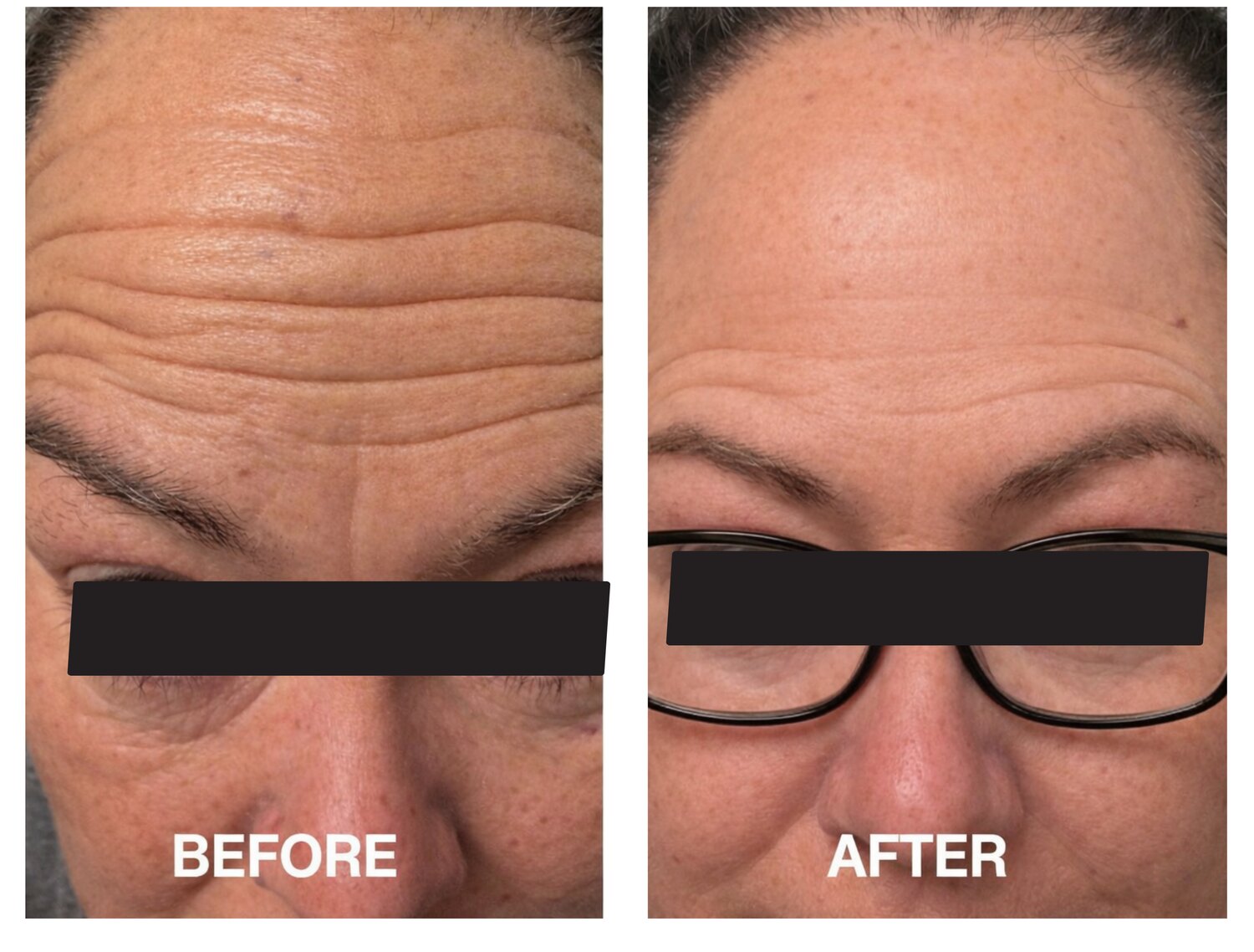 Botox  Forehead  Frown Lines before and after at Serene Med Spa Hudson