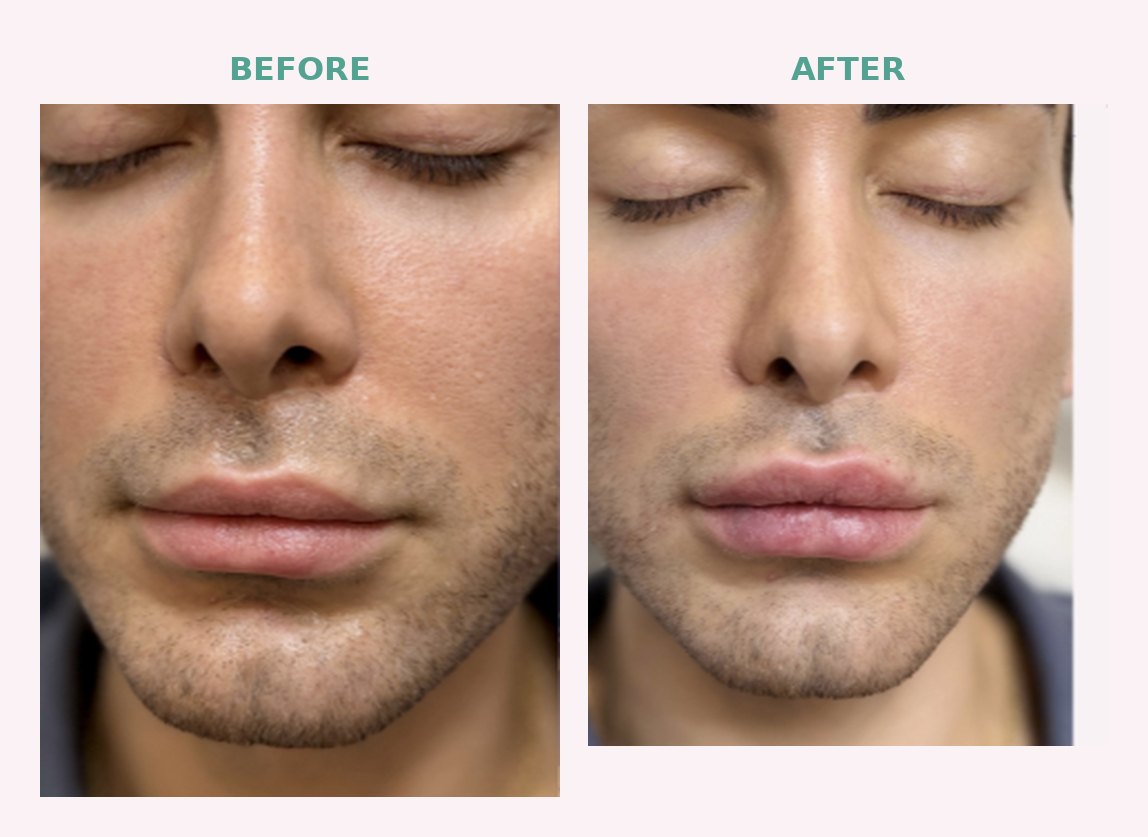 Before and after lip filler results at Serene Med Spa Hudson