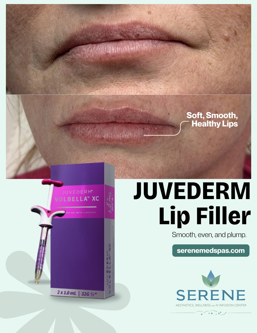 Lip Filler  Natural Volume before and after at Serene Med Spa Hudson