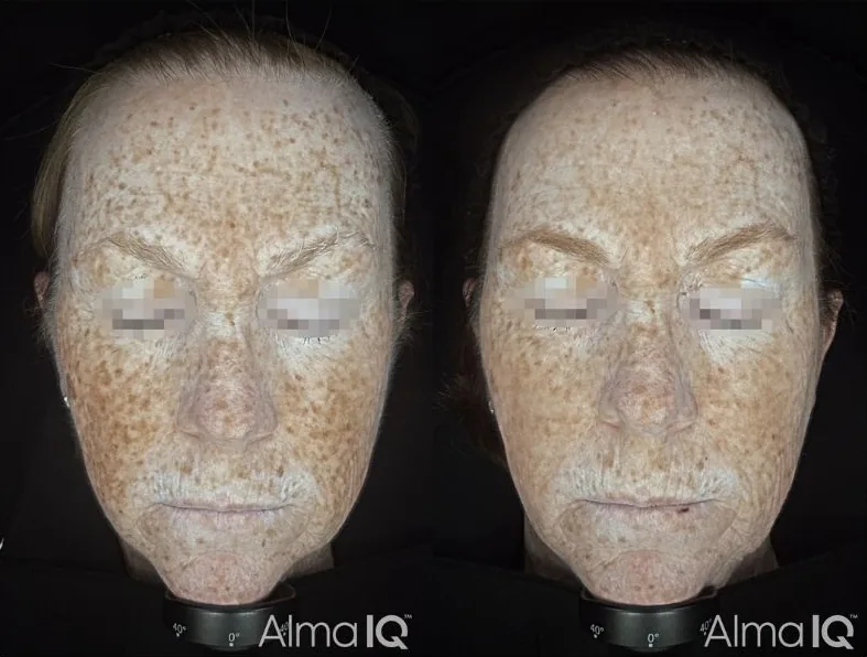 Harmony Bio-Boost before and after, pigmentation view, one month after one treatment