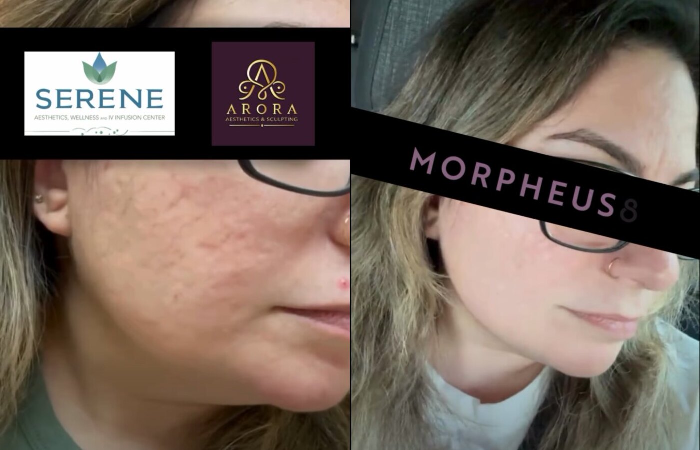 Morpheus8  Skin Tightening before and after at Serene Med Spa Hudson