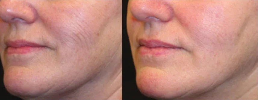 Opus Plasma before and after: jawline and lower face, after 2 treatments