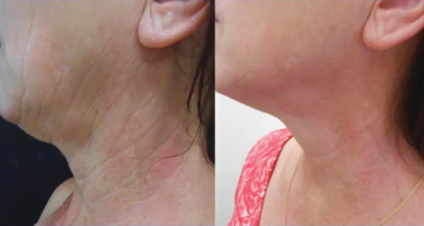 Opus Plasma before and after: neck lines and laxity, after 1 treatment