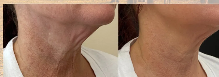 Opus Plasma before and after: crepey neck, after 3 treatments