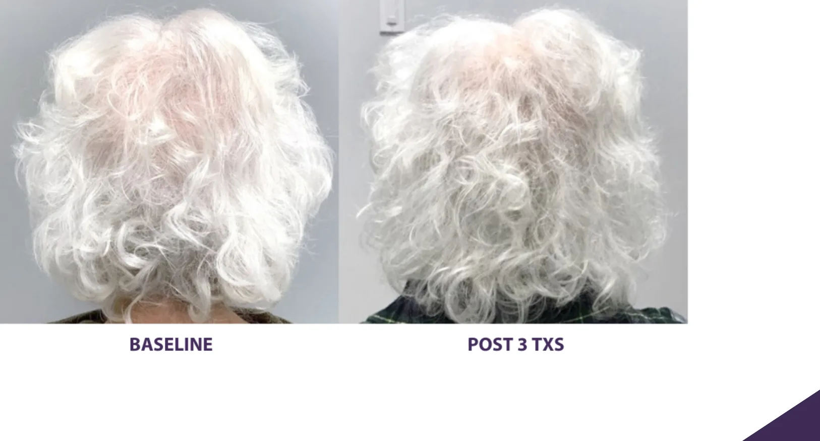 Alma TED hair restoration before and after: thinning crown, after 3 treatments