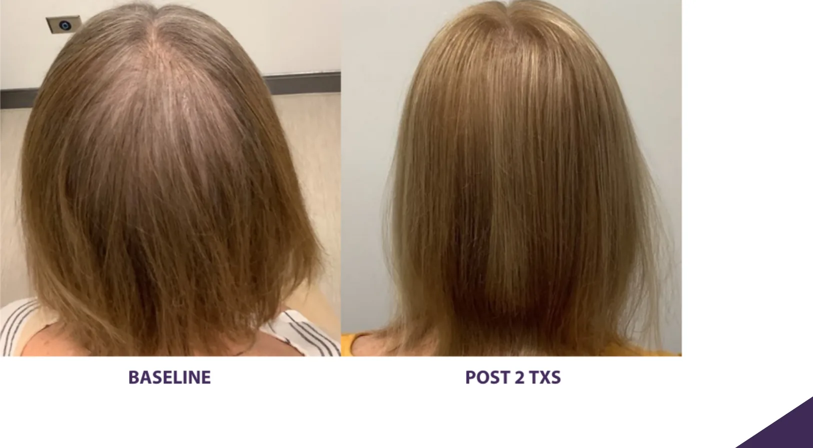 Alma TED hair restoration before and after: woman's part and crown, after 2 treatments